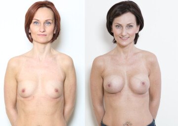 Průběh operace - Paní Lenka - zvětšení prsou s implantáty