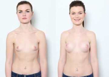 Průběh operace - Slečna Veronika - zvětšení prsou