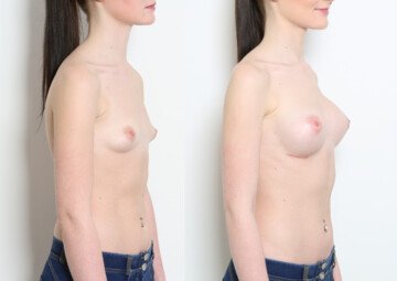 Průběh operace - Slečna Veronika - zvětšení prsou
