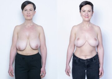 Průběh operace - Paní Iva - zmenšení prsou