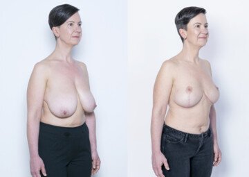 Průběh operace - Paní Iva - zmenšení prsou