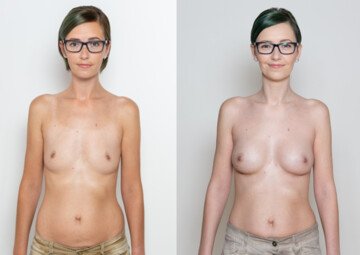 Průběh operace - Paní Veronika - augmentace prsou