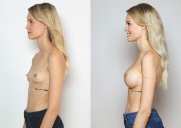 Průběh operace - Paní Zuzana - augmentace prsou