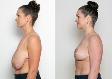 Průběh operace - Paní Kateřina - zmenšení prsou