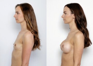 Průběh operace - Paní Michaela - augmentace prsou