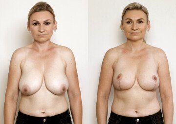 Průběh operace - Paní Zdeňka - zmenšení prsou