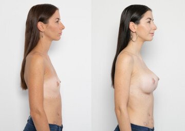 Průběh operace - Paní Tereza - augmentace prsou