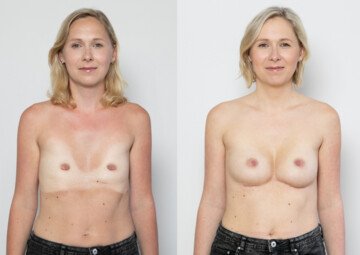 Průběh operace - Paní Zuzana - kompozitní augmentace prsou