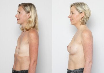 Průběh operace - Paní Zuzana - kompozitní augmentace prsou