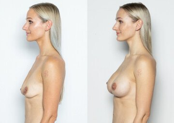 Průběh operace - Paní Radka - augmentace prsou