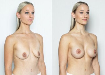 Průběh operace - Paní Radka - augmentace prsou