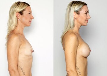Průběh operace - Paní Lucie - augmentace prsou