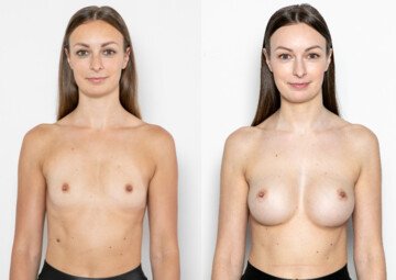 Průběh operace - Paní Edita - augmentace prsou