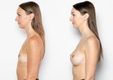 Průběh operace - Paní Edita - augmentace prsou