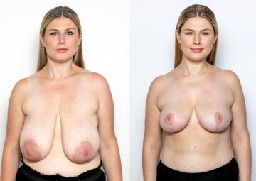 Průběh operace - Paní Aneta - zmenšení prsou